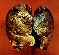http://tbn4-beta.google.com/images?q=tbn:VOt3N0SQMrBU_M:http://www.your-doctor.net/images/chest/smoking/smoker_lung.jpg